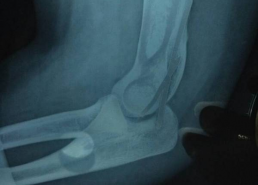 骨折打石膏图片,石膏固定术在骨折治疗中的应用与效果解析